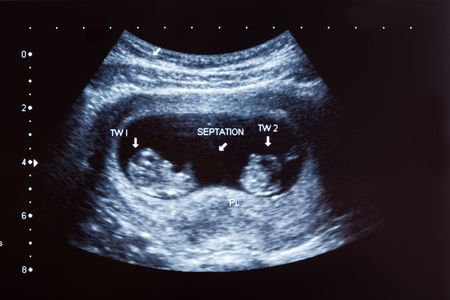 6102095 - ultrasound scan of 10 months old twin boys